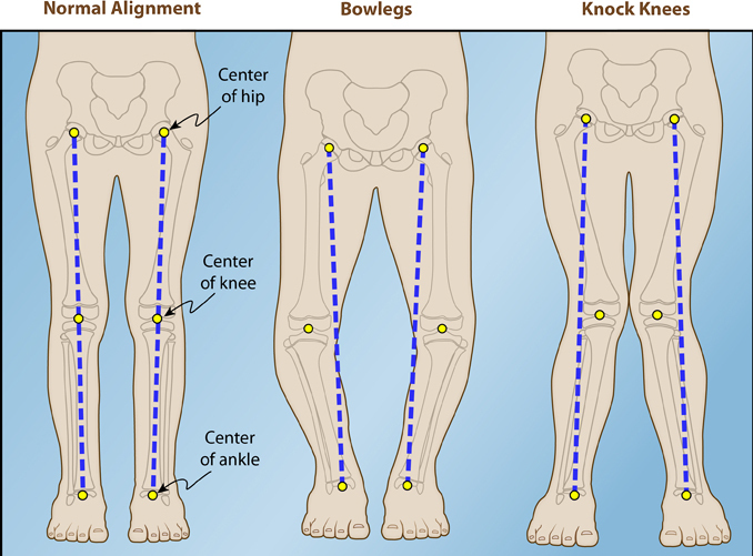 comparison of knock knee and bow legs