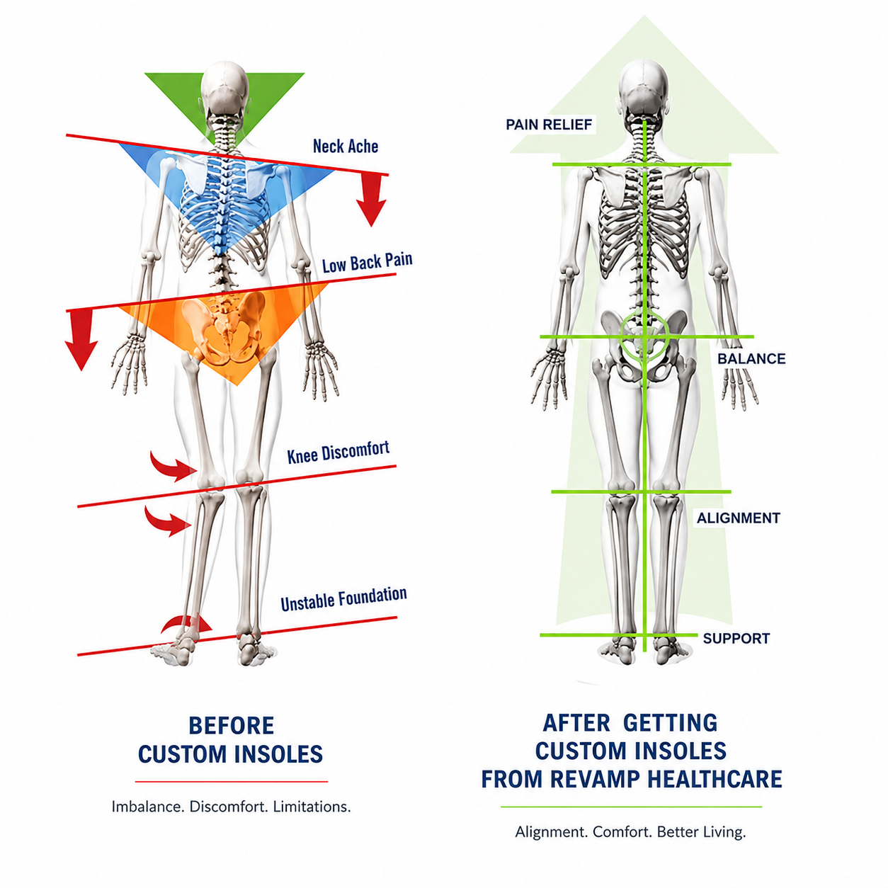 image showing how custom insoles help in better biomechanical alignment]