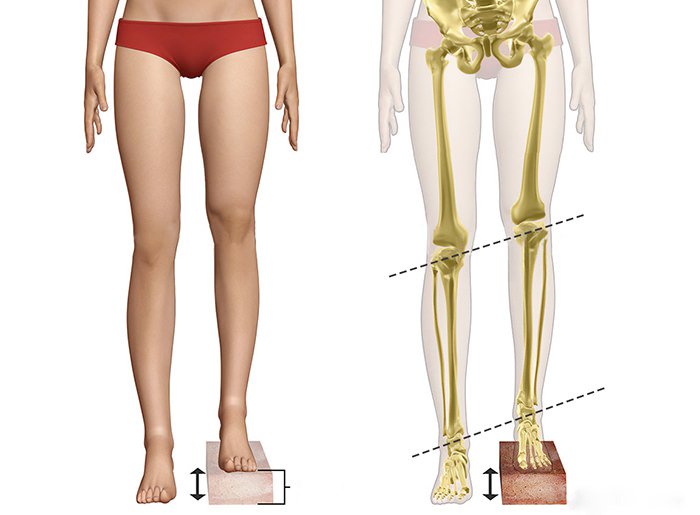 effects of leg length discrepancy on posture